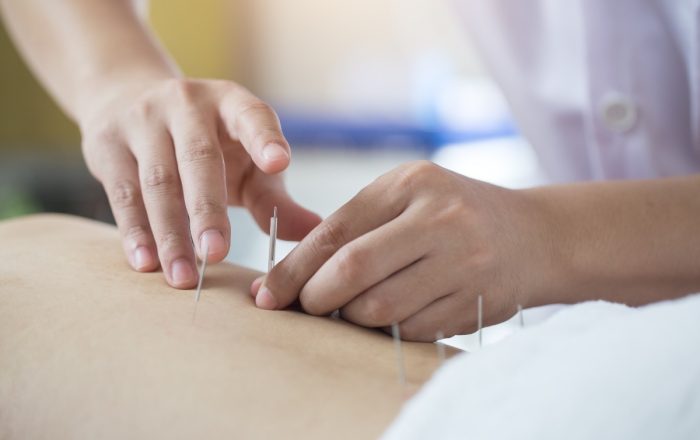 Acupuncture